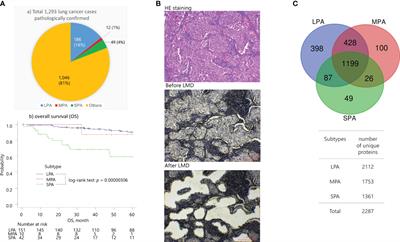 Cancer cell immunity-related protein co-expression networks are associated with early-stage solid-predominant lung adenocarcinoma